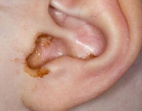Is Ear Syringing safe?